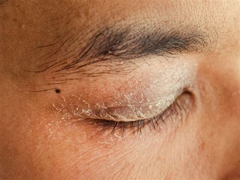 Rash Around Eyes Causes Symptoms And Treatment