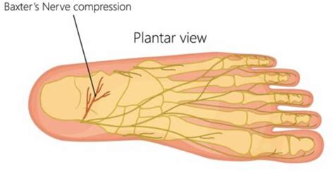 Foot Pain In The Morning Causes Symptoms And Best Treatment