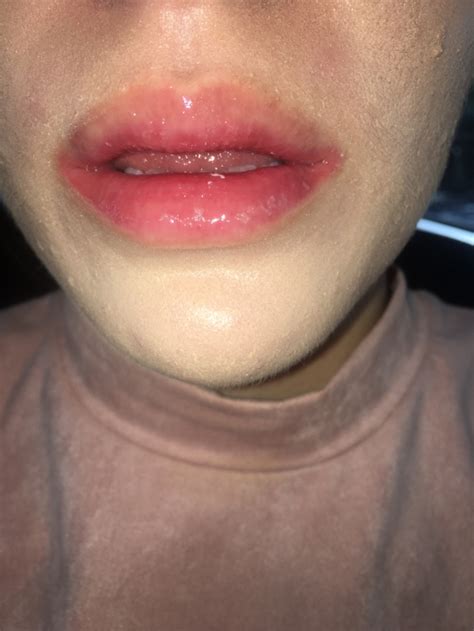 Raw Red Lips Please Help Accutane Isotretinoin Logs