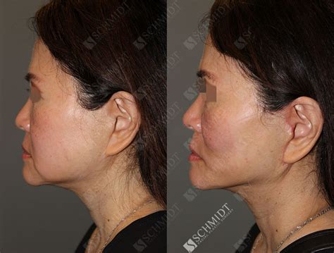 8597 Schmidt Facial Plastic Surgery