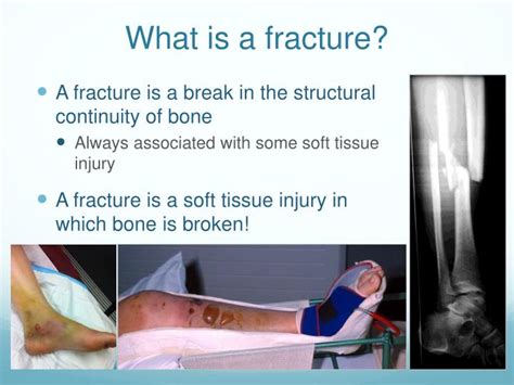 Ppt Principles Of Fractures And Fracture Management Powerpoint