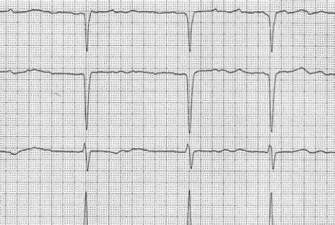 Flutter Atriale Sintomi Cause E Trattamento Vivere Al Meglio