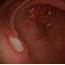 Stomach Ulcers Related To Hpylori  Endoscopic Images