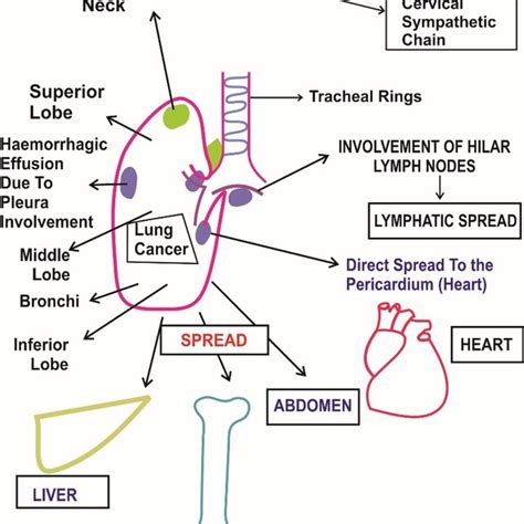 Lymphatic Spread Of Lung Cancer Download Scientific Diagram