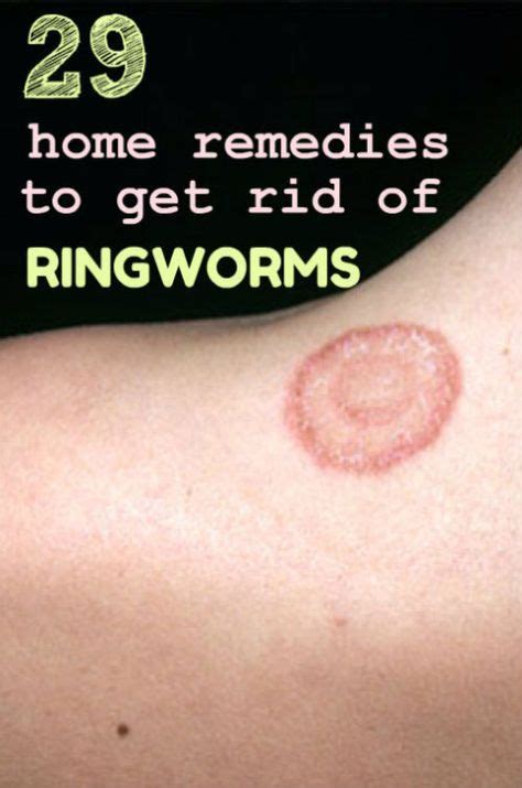 Home Remedy Hacks • 29 Home Remedies To Get Rid Of Ringworm Fast Get