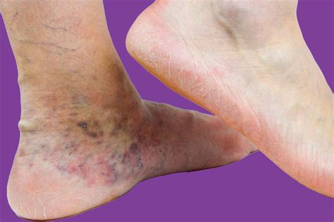 Venous Stasis Dermatitis Symptoms Causes Treatments And More