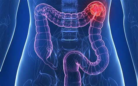 5 Hidden Signs Of Colon Cancer That You Need To Know Health Advice