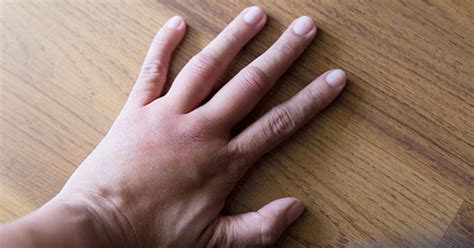 What Causes Swollen Knuckles And How To Reduce Swelling