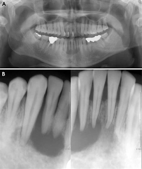 Figure 2 From Eosinophilic Granuloma In The Anterior Mandible Mimicking
