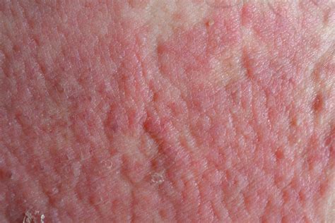 Severe Active Atopic Eczema Tied To Increased Mortality Risk Mdnewsline