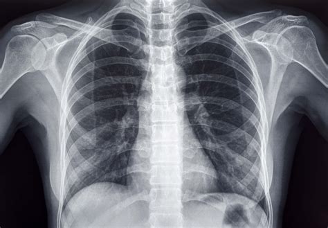 X Ray Iowa Radiology