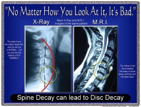 Herniated Disc Chiropractor In St Paul Chiropractor St Paul Mn