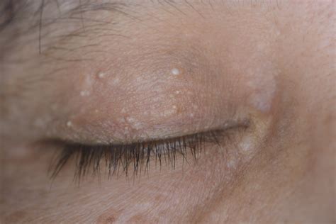Bump On Eyelid Near Lash Line Find Out How To Distinguish Between