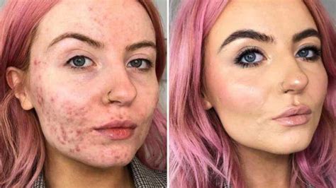 Before And After Makeup For Acne Skin