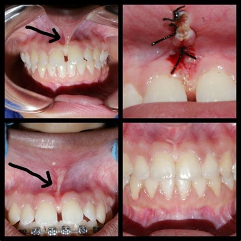High Frenal Attachment Leading To Spacing Or Gaps In Between Teeth