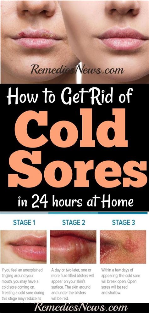 how to get rid of cold sores fast in 24 hours at home 11 best home remedies to treat cold sore