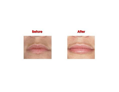 Permalip Lip Implants Clinic Harley Street London