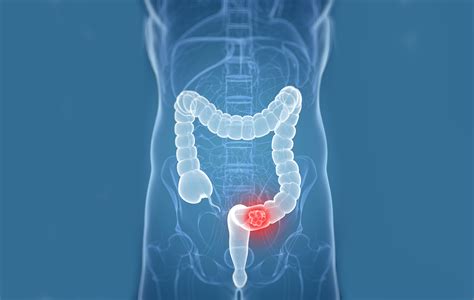 Colorectal cancer (crc) is the most common cancer of the gastrointestinal tract and the second most frequently diagnosed malignancy in adults. Colorectal Cancer: 6 Things You Must Understand About It
