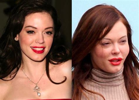 Celebrities Before And After Plastic Surgery Part Musely
