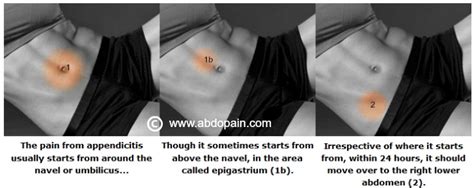 See the appendix pain location as depicted in the pictures here. Appendix Pain Location - Where Appendicitis Pain Starts ...