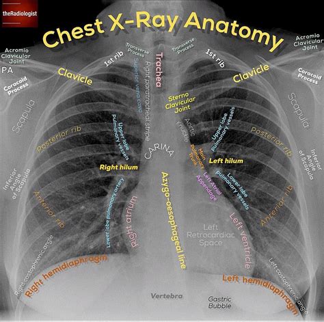 👨🏽‍💻heres A Recap Of Three Posts On Chest X Ray Anatomy From The Last