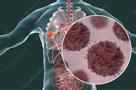 Lung Cancer Illustration Stock Image F0221933 Science Photo Library