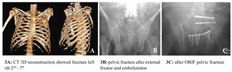 Rib Fracture Fixation With Osteosynthesis Plates In Bangkok Hospital