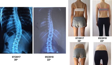 Schroth Scoliosis And Spine Clinic On Twitter Treatment Result For Adolescent Idiopathic