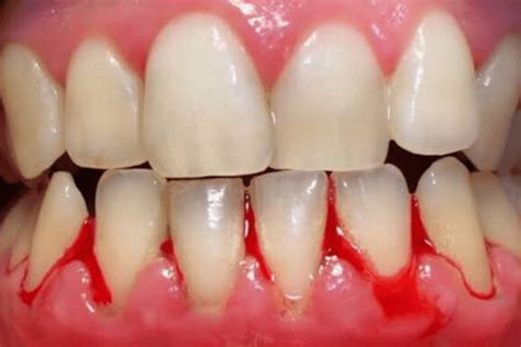 Gum Disease Know The Signs And Symptoms