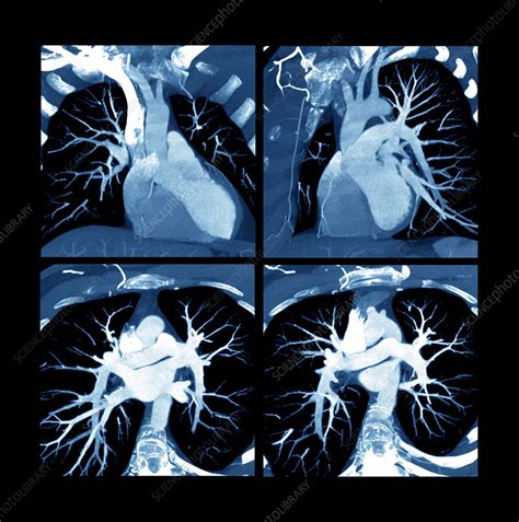 Heart Ct Scan Stock Image P2160488 Science Photo Library
