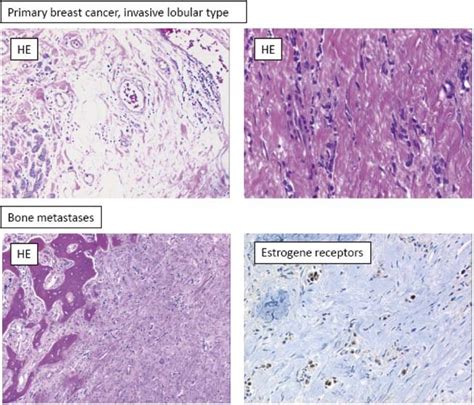 Histology Of The Primary Invasive Lobular Breast Cancer Magnification
