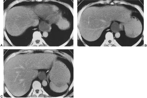 The Mediastinum Radiology Key