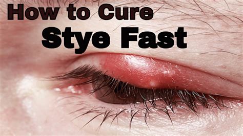 How To Soothe A Stye Fast How To Get Rid Of Stye Vitalife Show