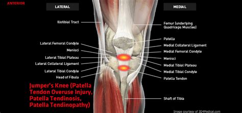 Injury to the achilles tendon causes pain along the back of your leg near the heel. Jumper's Knee (Patella Tendon Overuse Injury, Patella Tendinosis, Patella Tendinopathy ...