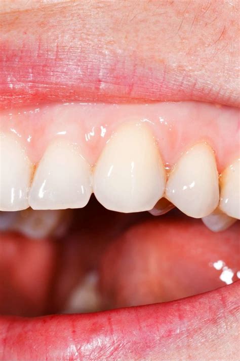 Pale Gums Causes Symptoms Treatment And Warning Signs