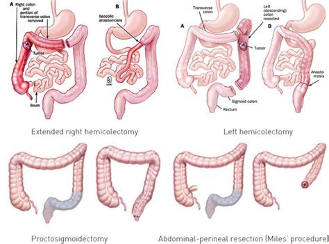 Colorectal Resection Fv Hospital