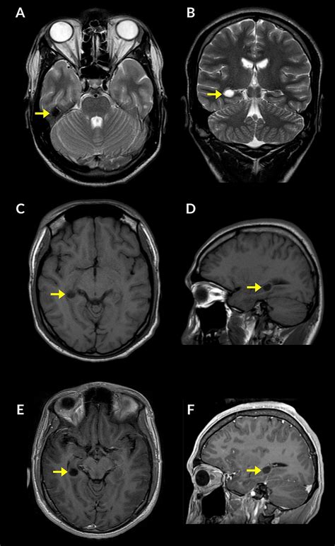 Brain Magnetic Resonance Imaging Mri Scan In A Patient With Dnet Download Scientific Diagram
