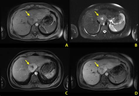 Cureus A Review Of Benign Hepatic Tumors And Their Imaging