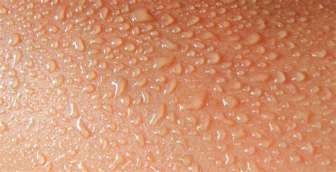 What I Tell My Patients Hyperhidrosis Dermatology In Practice