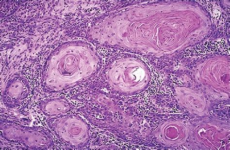 Other histologies such as squamous, adenosquamous, carcinoid tumors, or lymphoid tumors are occasionally identified. Pathology Outlines - Squamous cell carcinoma (SCC)