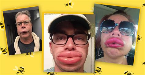 people share their worst ever bee sting lips worldmedicinefoundation