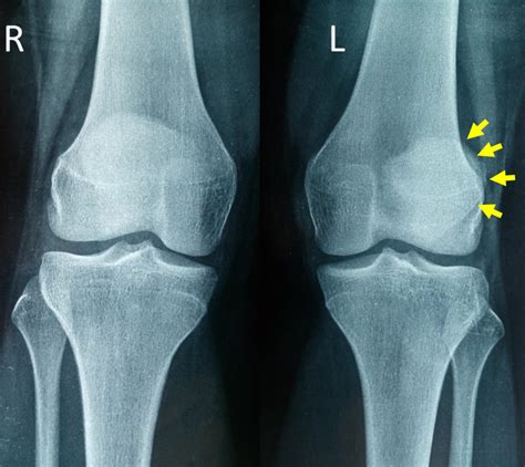 Avulsion Fracture Knee