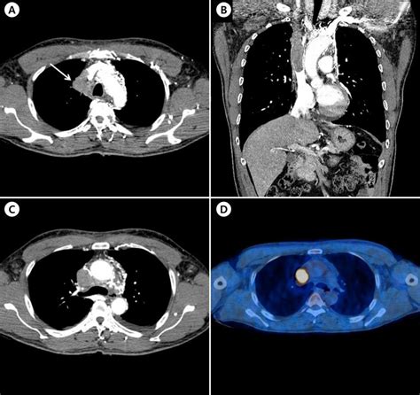 Endobronchial Ultrasound Imaging And Pathology Specimens From Ebus Tbna