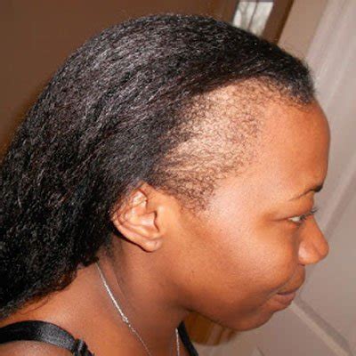 A receding hairline can happen to men of all ages. 9 Ways To Save A Receding Hairline - Glamtush