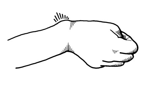 The Milwaukee Hand Center Dr. Greg Watchmaker