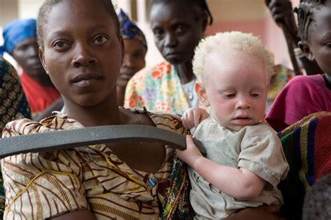 Les meurtres de personnes atteintes d albinisme ont augmenté pendant la pandémie experte de l