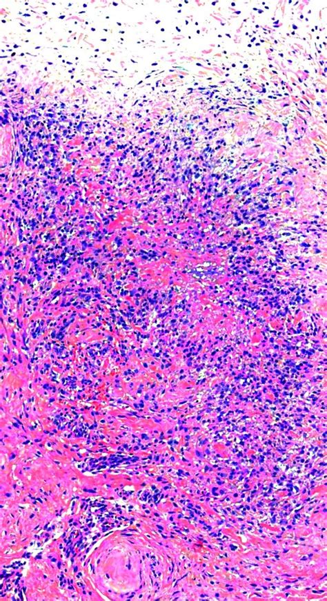 Pathology Of Granuloma Annulare