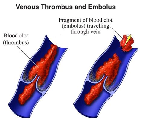 Treatment For Blood Clots In New Jersey Heart Vascular Thoracic