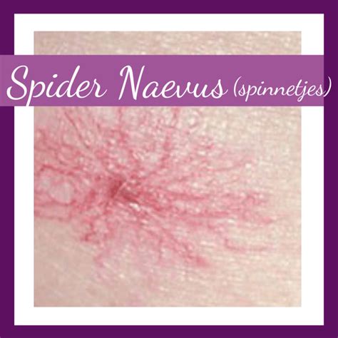 Spinnetjes Spider Naevus Huidoneffenheden Verwijderen