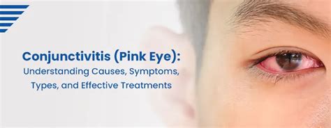 Conjunctivitis Pink Eye Causes Symptomstreatments Sprint